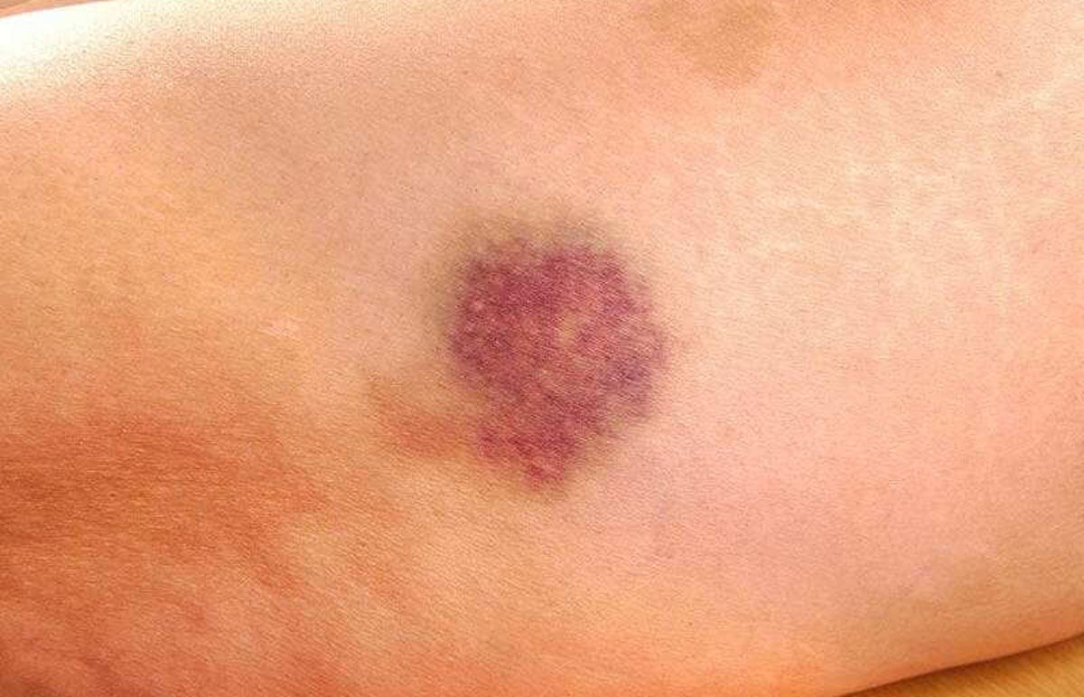 Vitamin K Deficiency Bruising