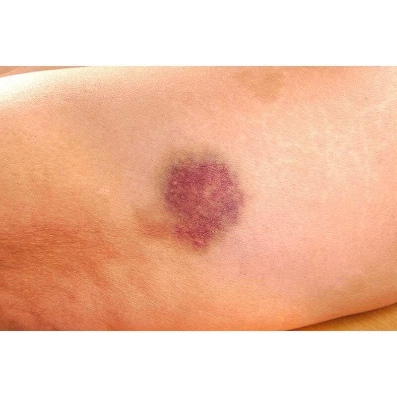 Treat bruised skin with topical Vitamin K