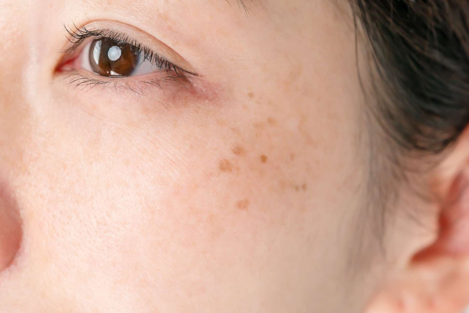 Understanding Skin Hyperpigmentation Pathways Causes Treatments And