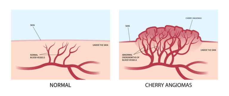 Understanding Cherry Angiomas: Causes & Treatment Options