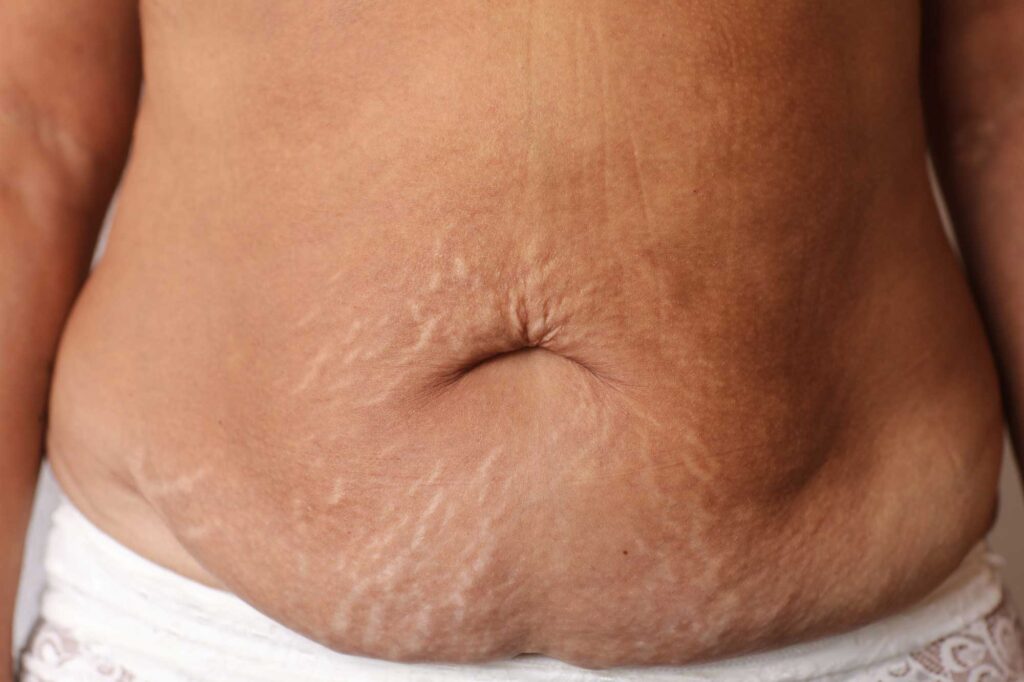 close up of woman s belly with stretch mark loose 2024 10 18 11 22 39 utc