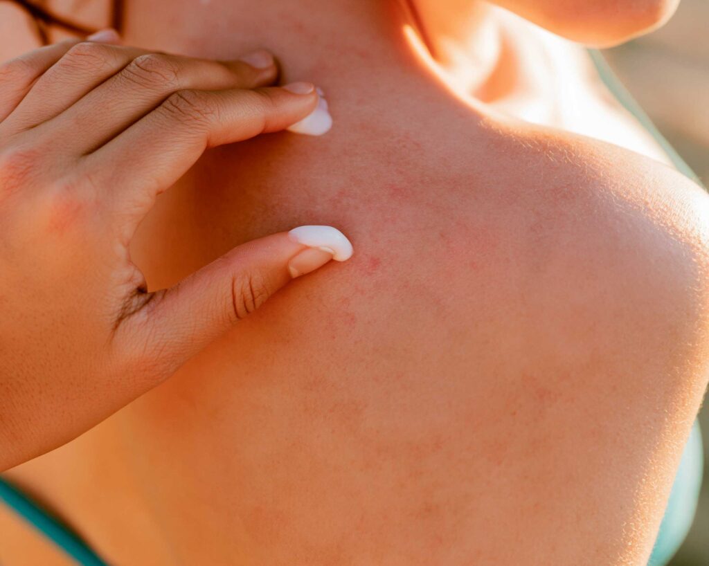 Applying cream to red rash on shoulder