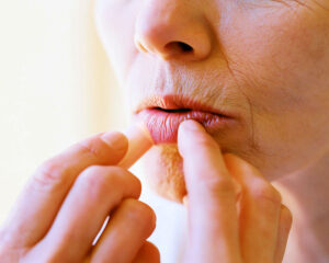 Person applying lip balm to dry lips