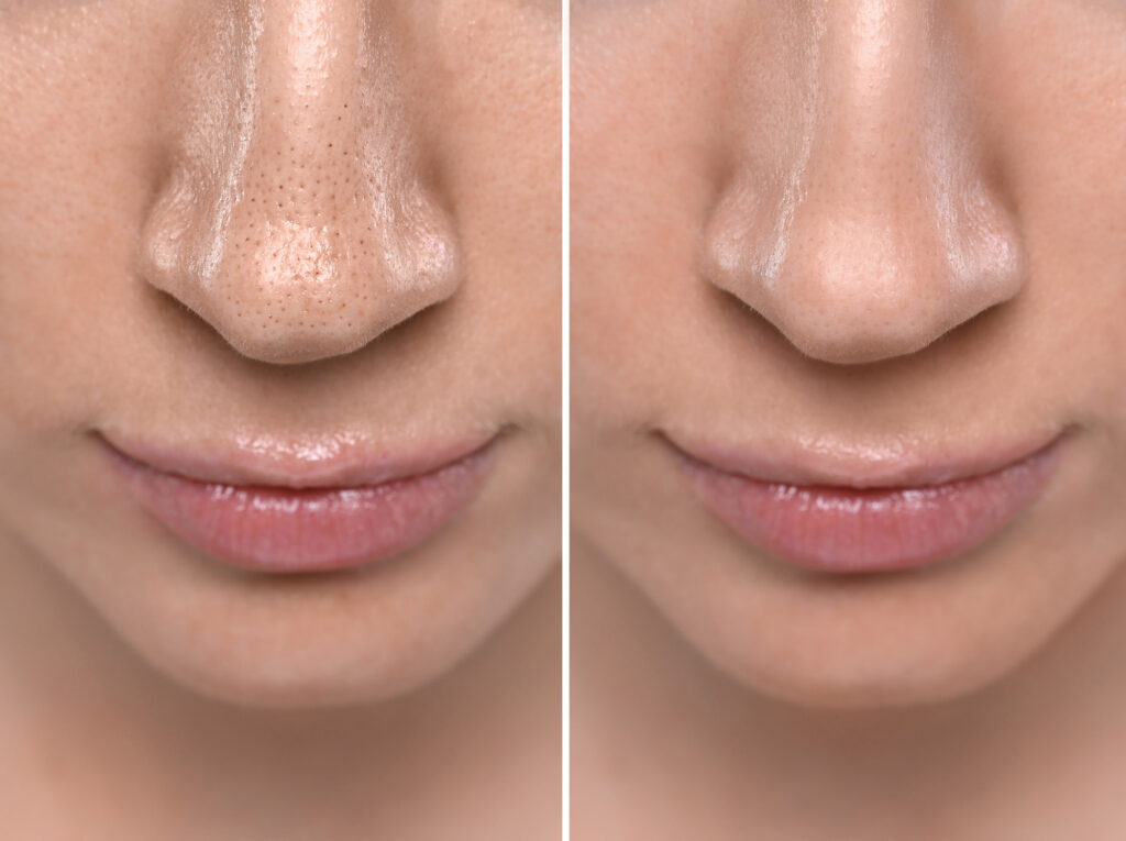 Before and after blackhead removal on nose