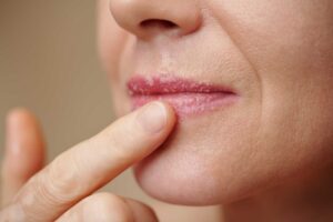 Close-up of lips with cold sore blisters