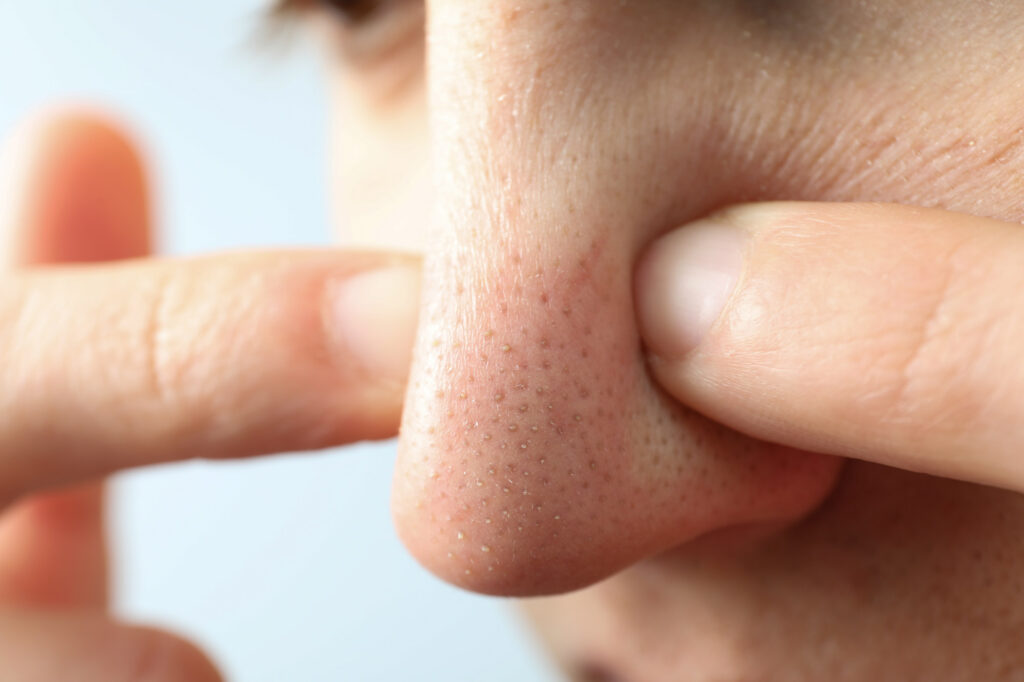 Close-up of blackheads on nose being squeezed