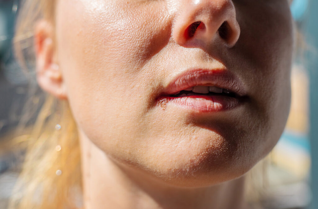 Close-up of woman with sore on lip