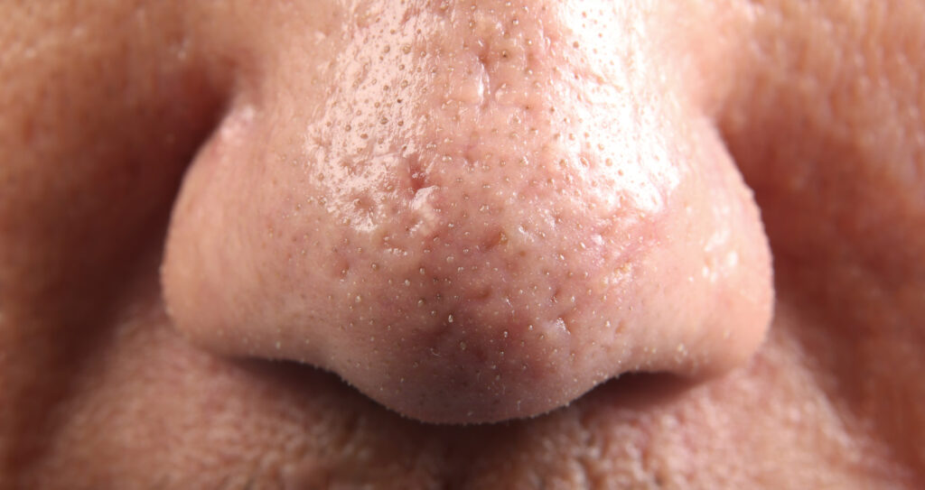Close-up of nose with blackheads and pores